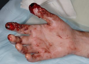 Fireworks Injury Caused To Patients’ Hand That Alastair Brown Has Treated